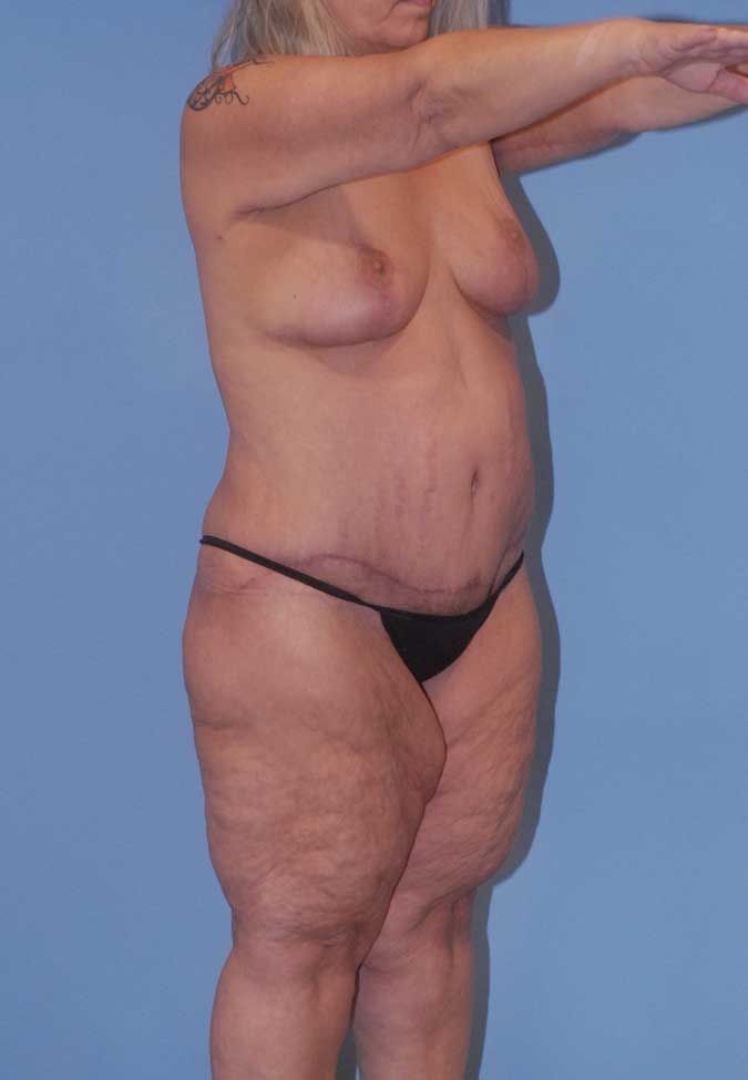 Liposuction Before & After