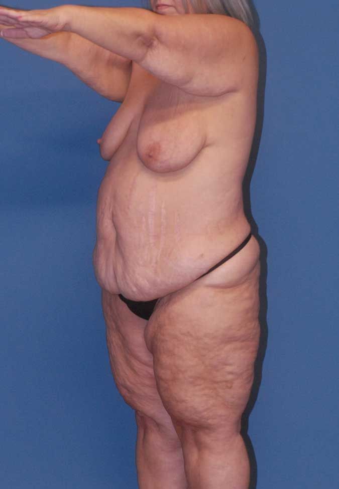 Liposuction Before & After