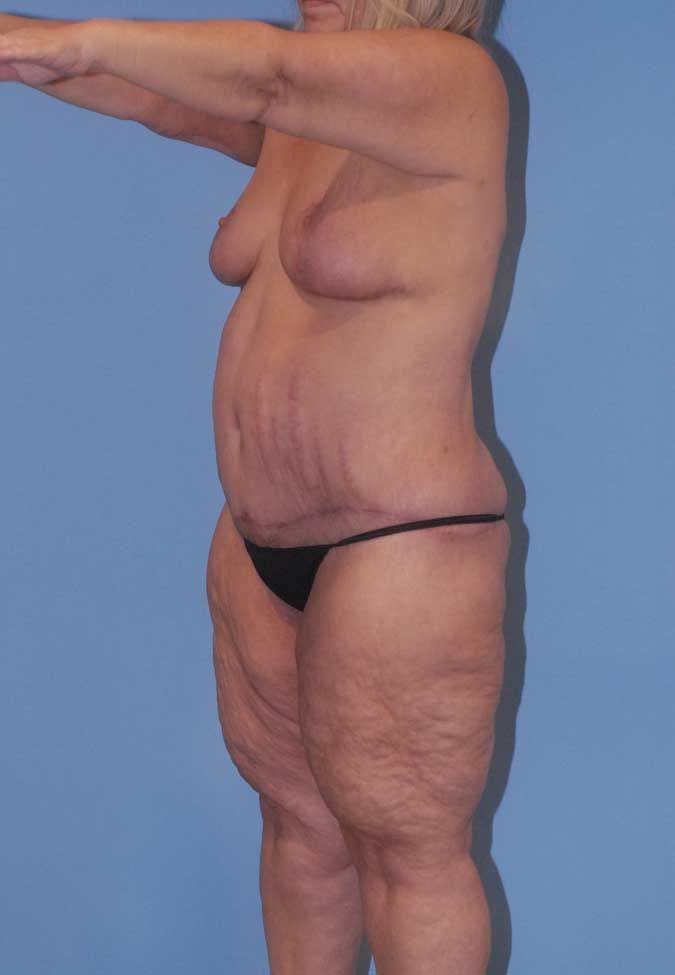 Liposuction Before & After