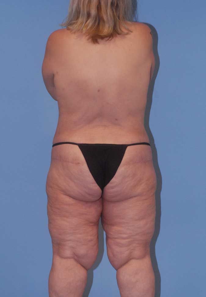 Liposuction Before & After