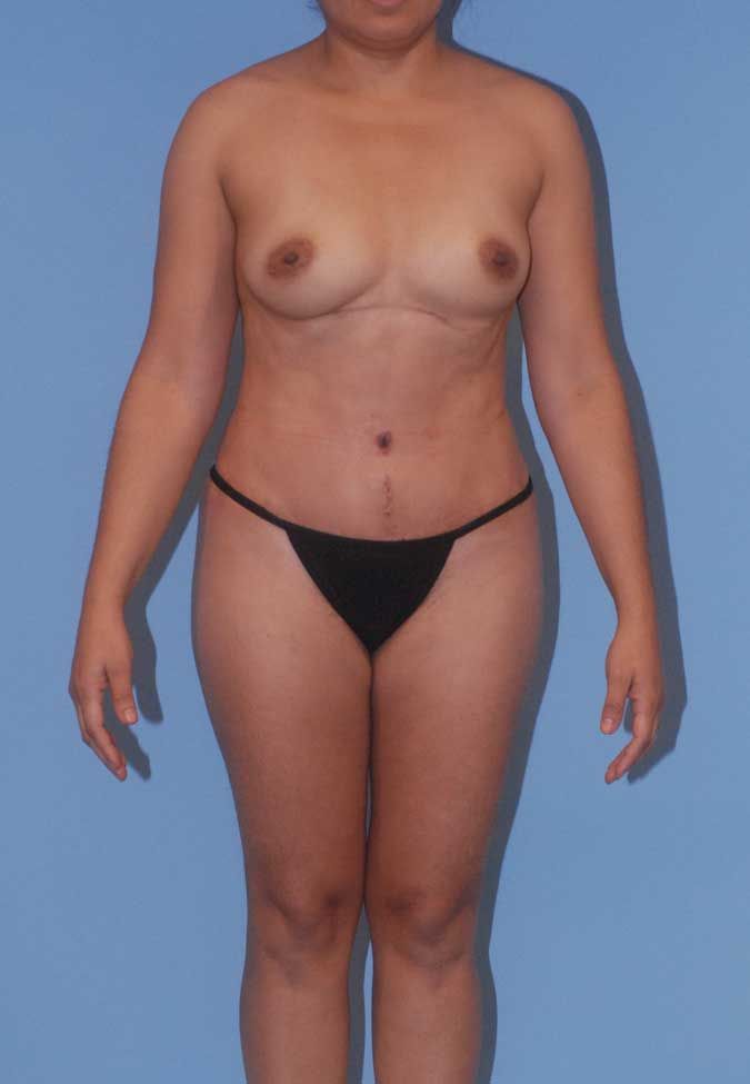 Liposuction Before & After