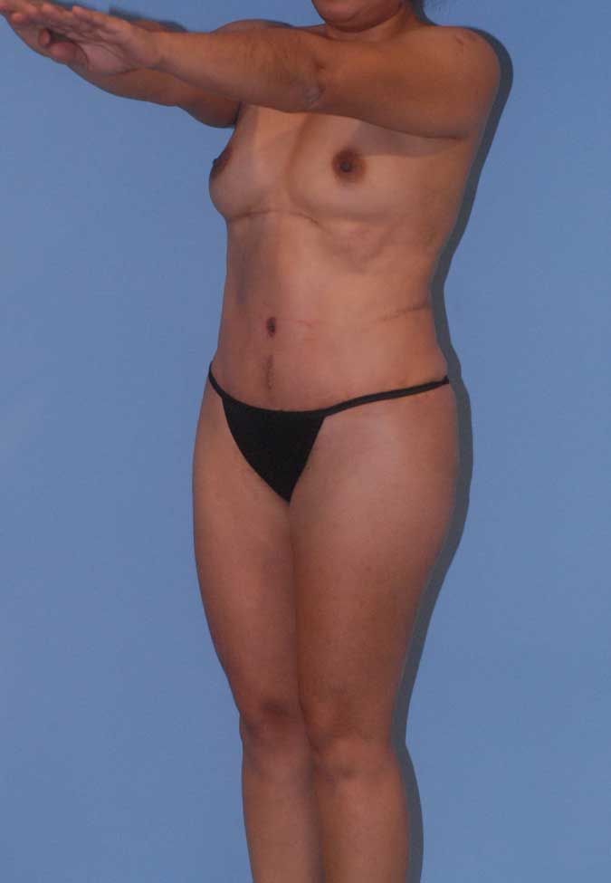 Liposuction Before & After