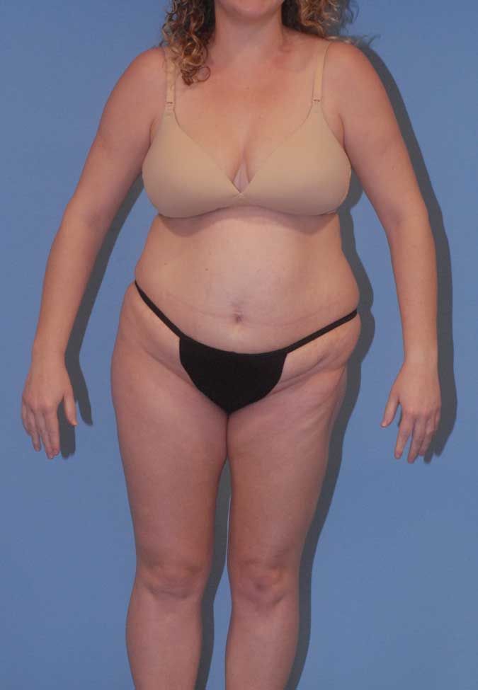 Liposuction Before & After
