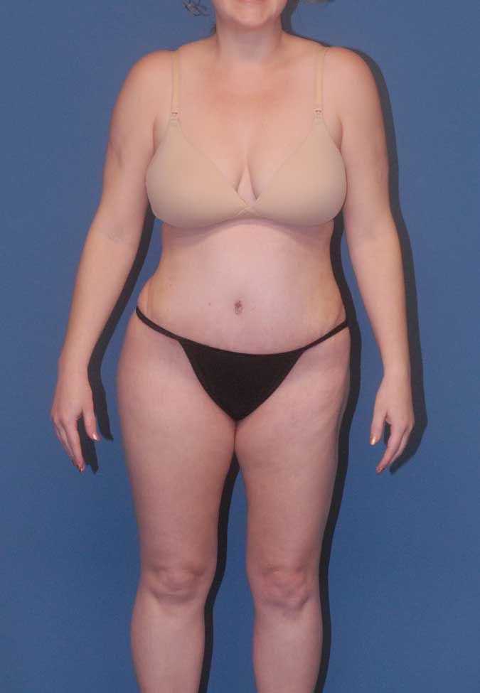 Liposuction Before & After