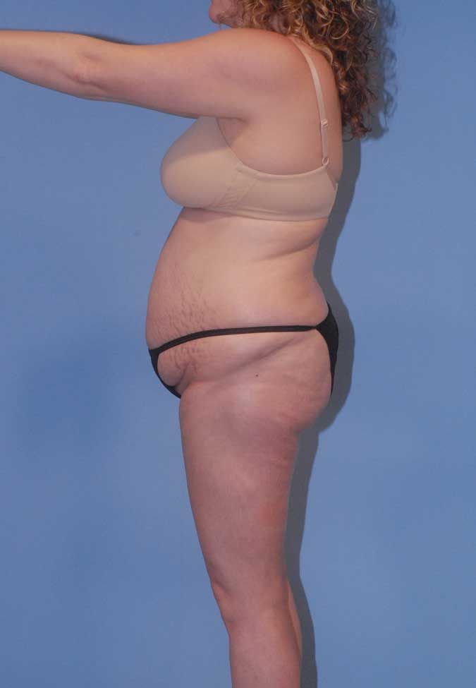 Liposuction Before & After