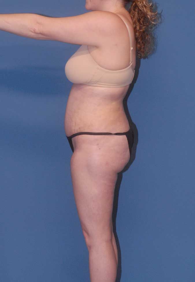 Liposuction Before & After