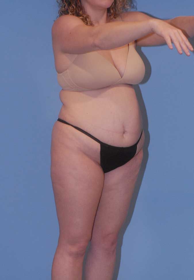 Liposuction Before & After
