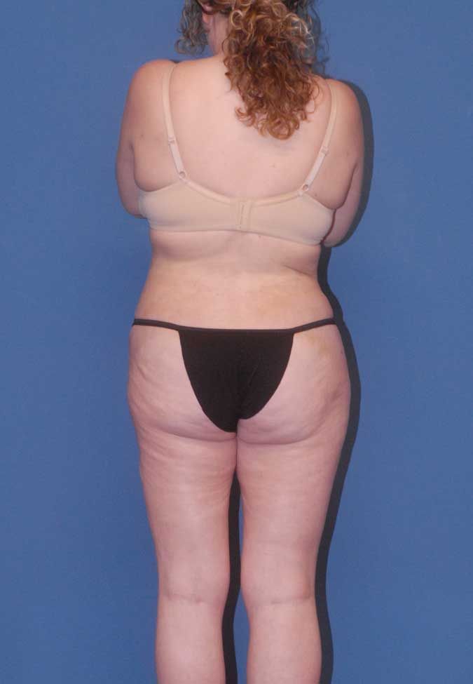 Liposuction Before & After