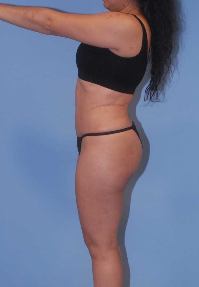 Liposuction Before & After