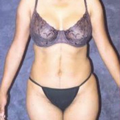 Liposuction Before & After