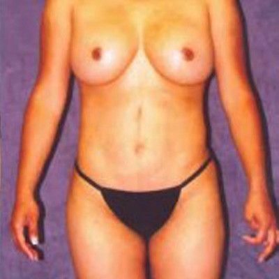 Liposuction Before & After
