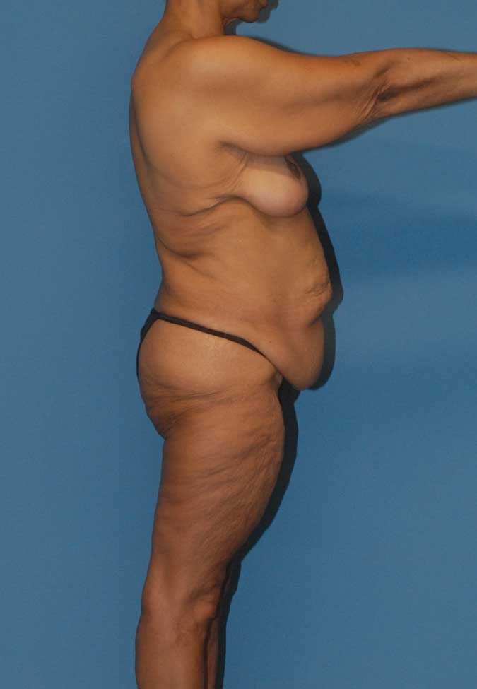 Liposuction Before & After