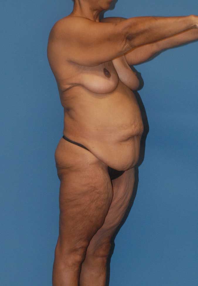 Liposuction Before & After