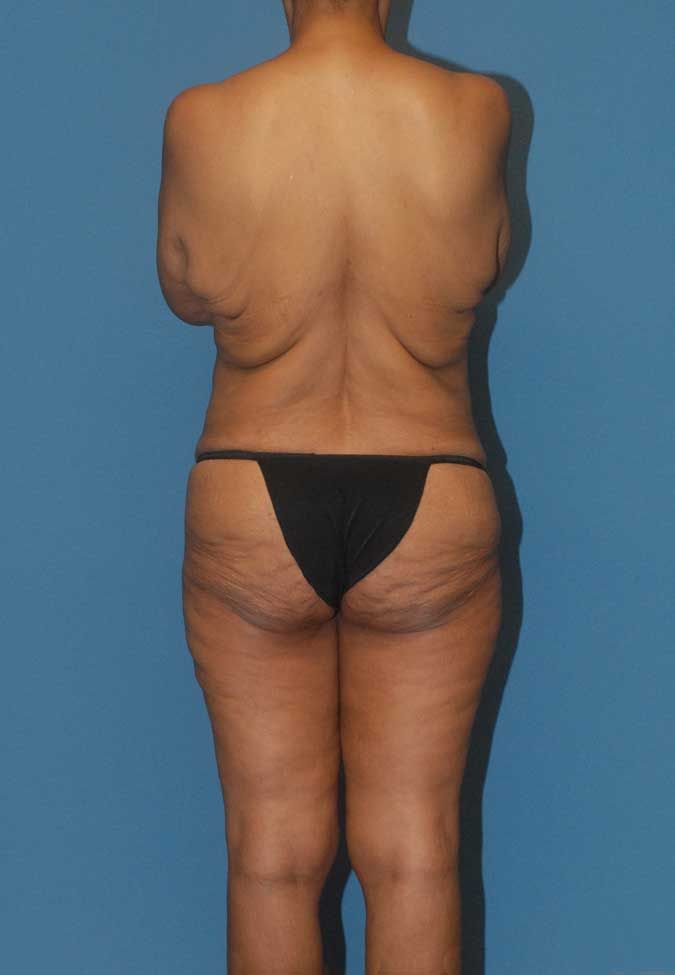 Liposuction Before & After