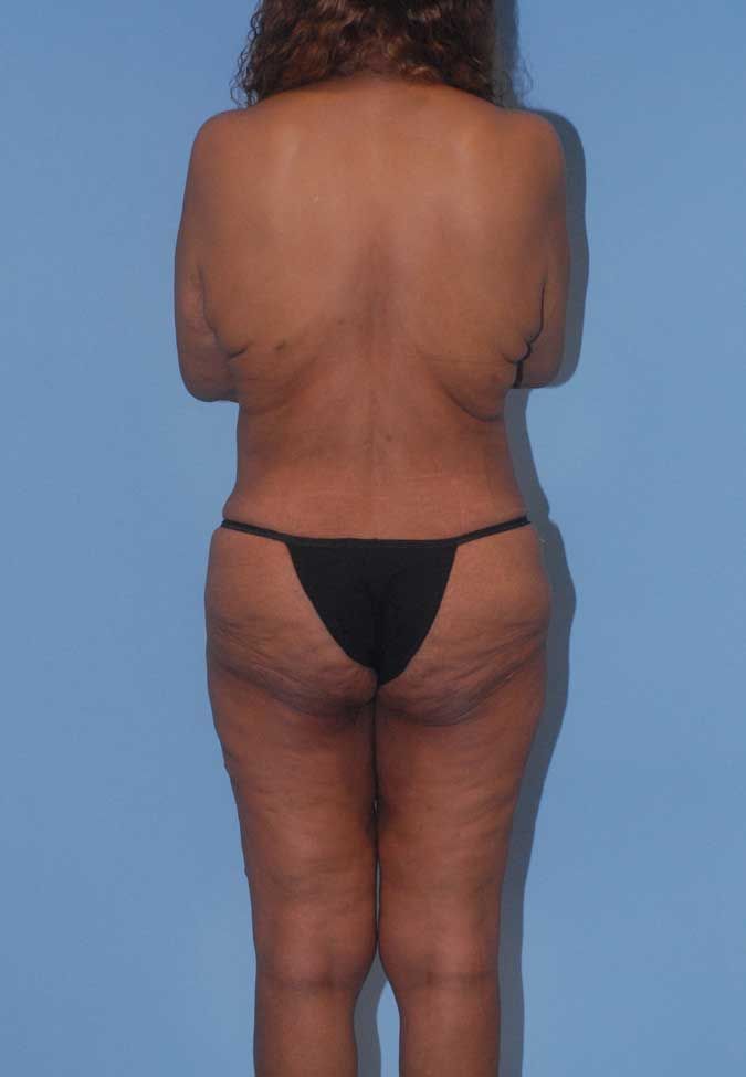 Liposuction Before & After
