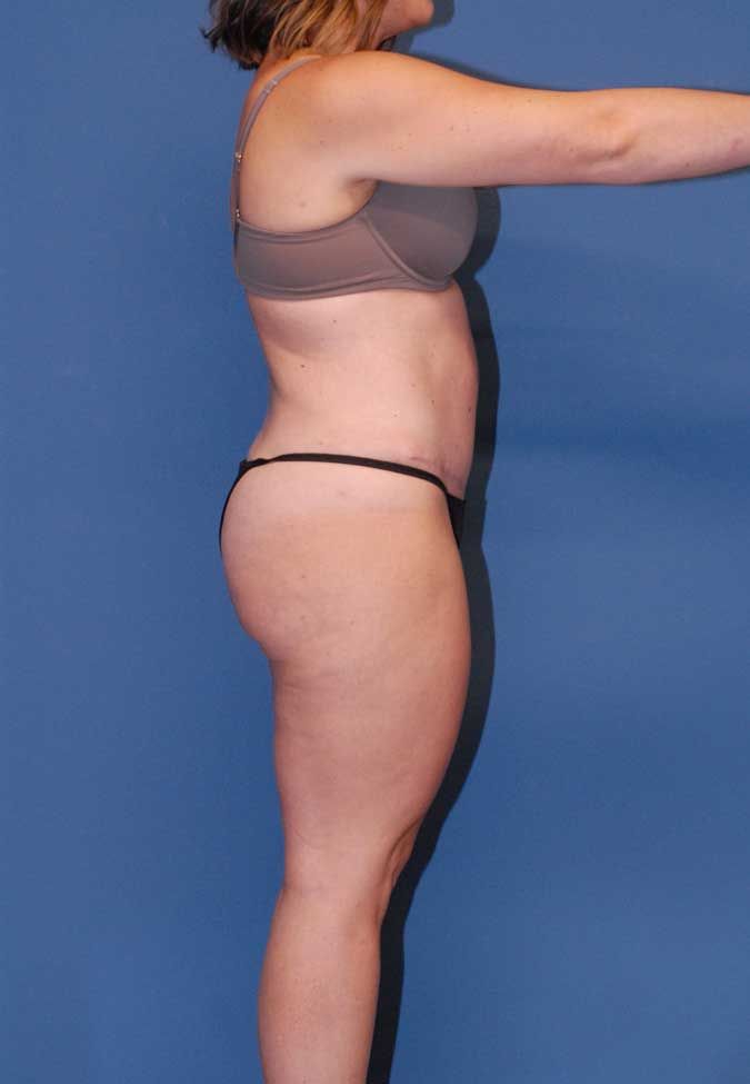 Liposuction Before & After