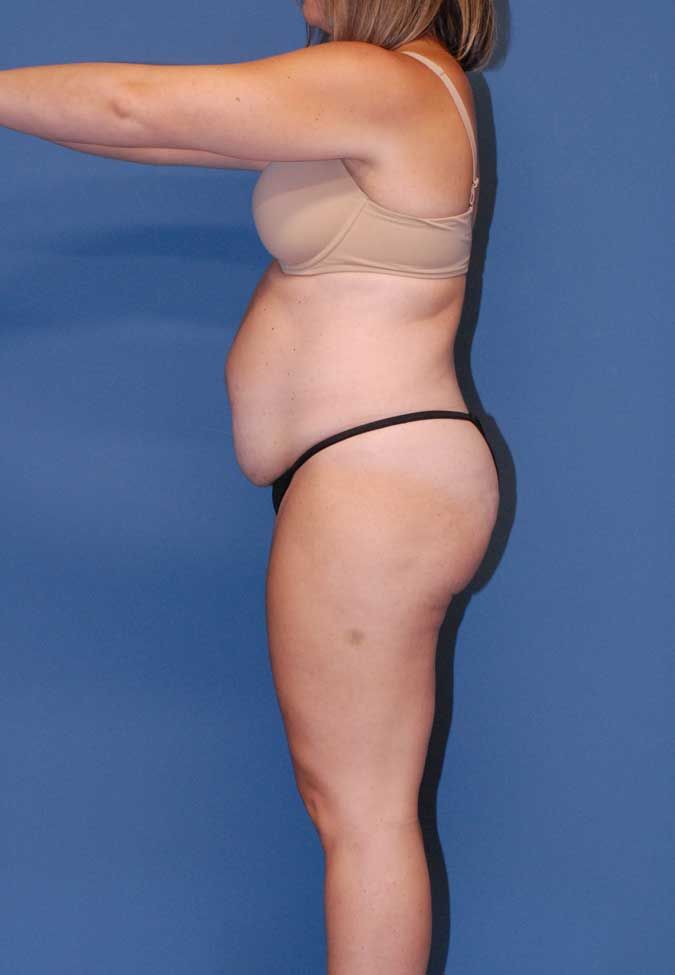 Liposuction Before & After