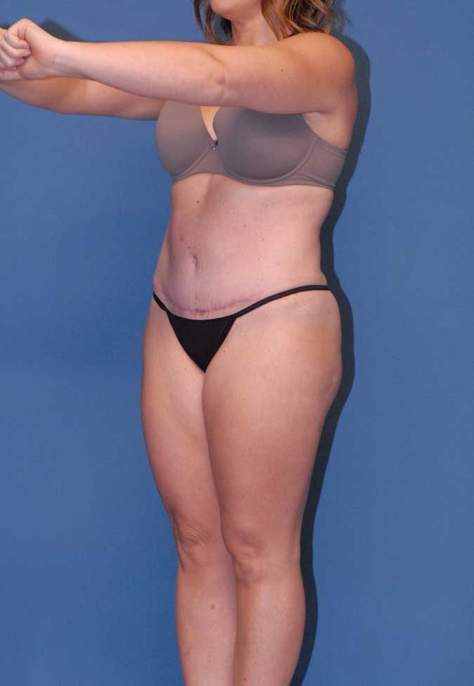 Liposuction Before & After