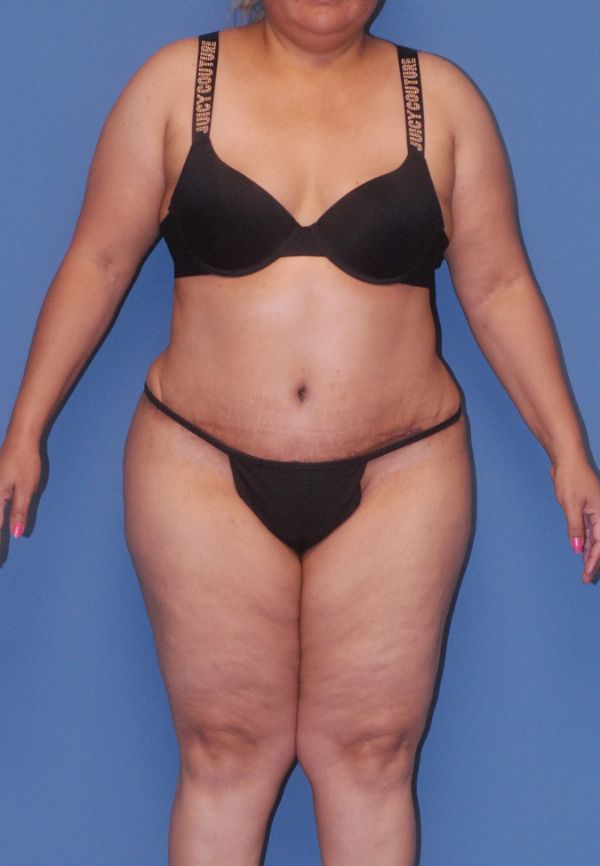 Liposuction Before & After