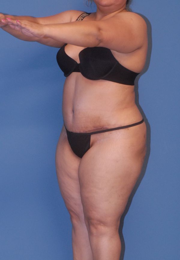 Liposuction Before & After