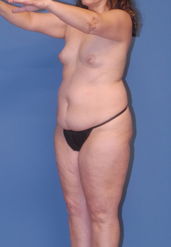 Liposuction Before & After