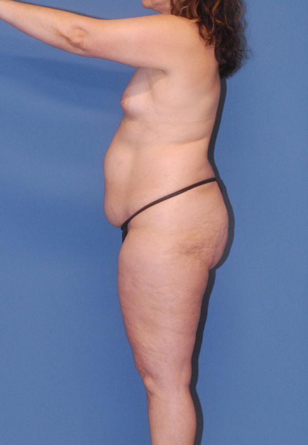 Liposuction Before & After