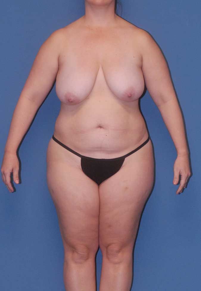Liposuction Before & After