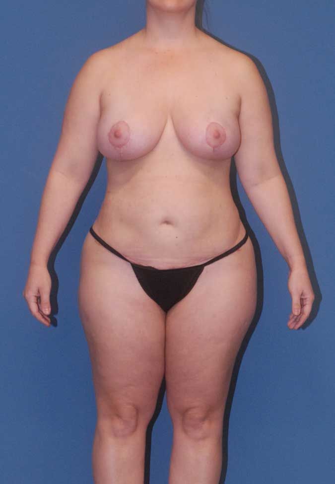 Liposuction Before & After