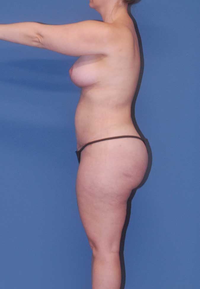 Liposuction Before & After