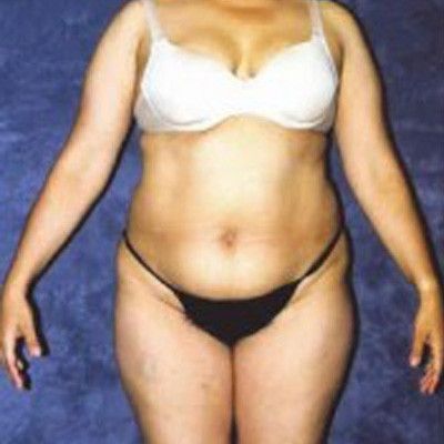 Liposuction Before & After