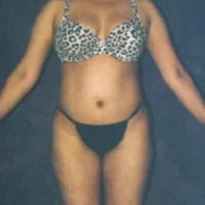Liposuction Before & After