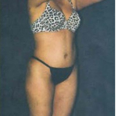 Liposuction Before & After