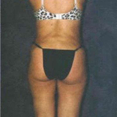 Liposuction Before & After
