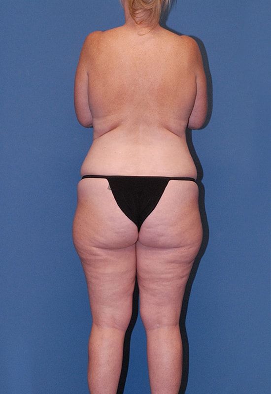 Liposuction Before & After