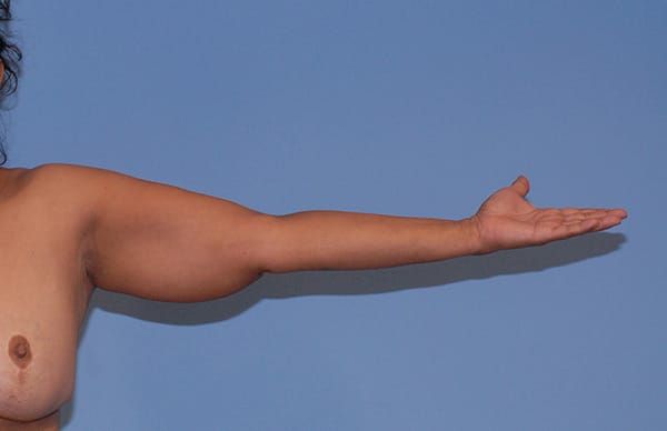 Liposuction Before & After