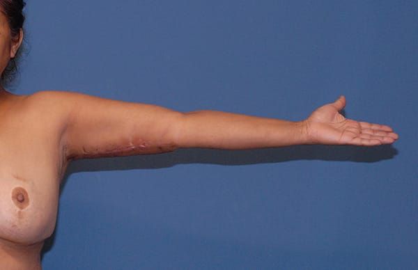 Liposuction Before & After