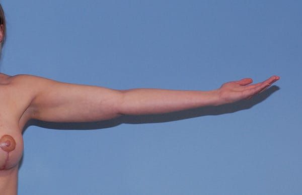 Liposuction Before & After