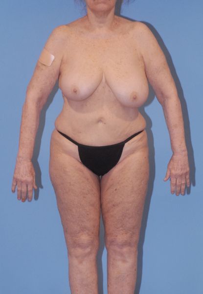 Liposuction Before & After