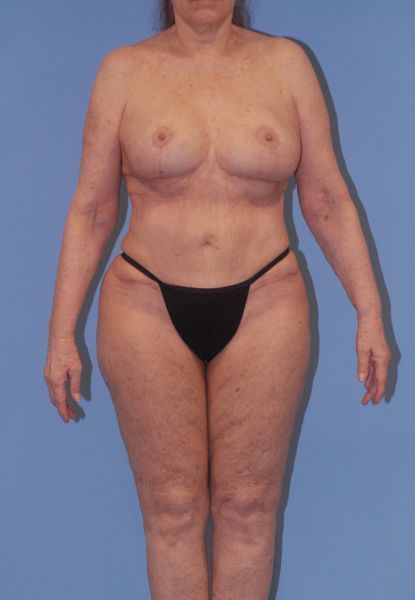 Liposuction Before & After