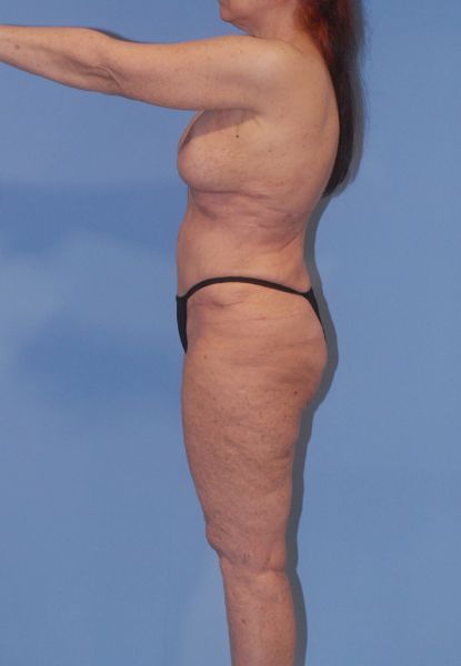 Liposuction Before & After