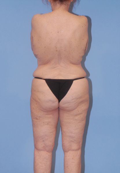 Liposuction Before & After