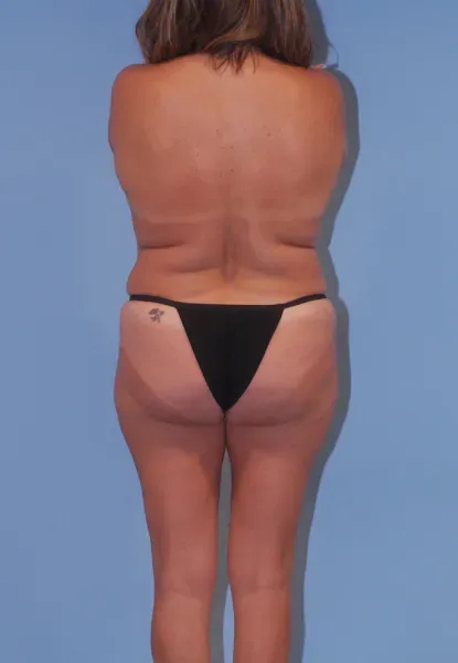 Liposuction Before & After