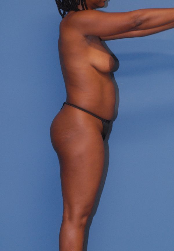 Liposuction Before & After