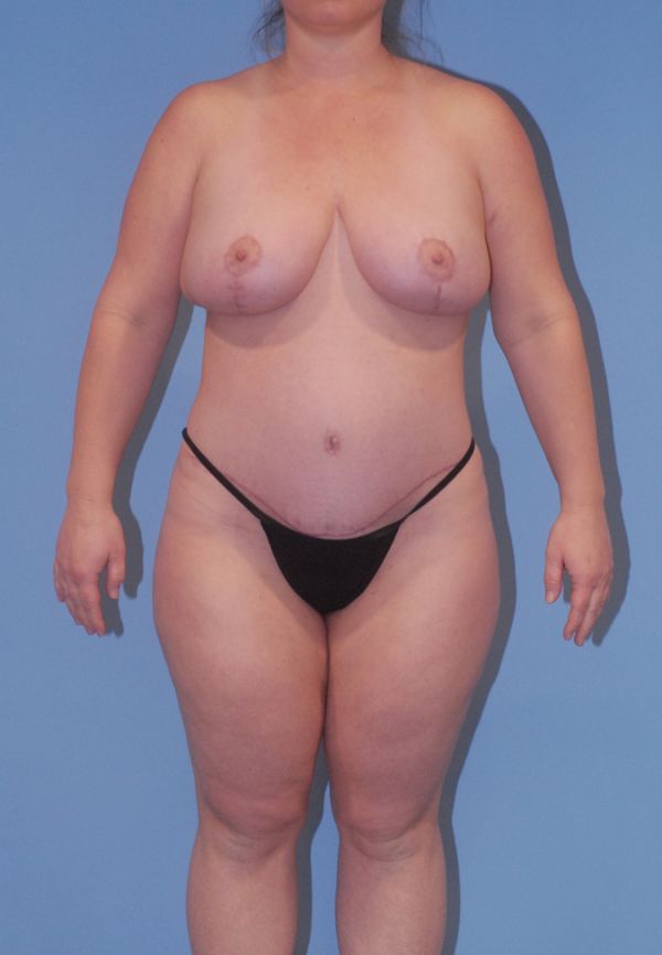 Liposuction Before & After