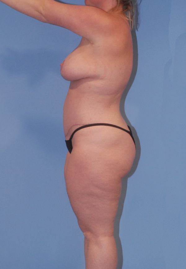 Liposuction Before & After