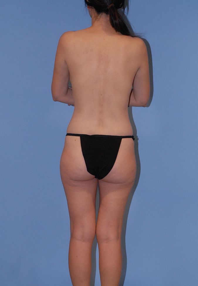 Liposuction Before & After