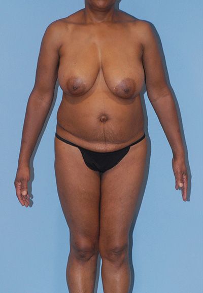 Liposuction Before & After