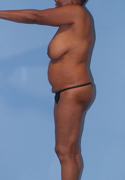 Liposuction Before & After