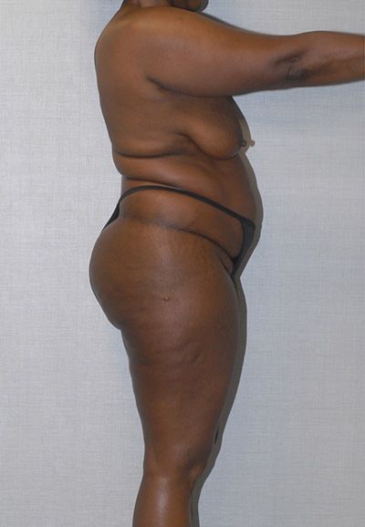 Liposuction Before & After