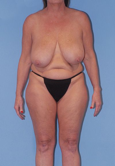 Liposuction Before & After
